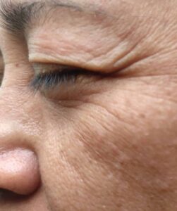 Por que a pele enruga conforme envelhecemos? Entenda mais e veja como melhorar a saúde do maior órgão do nosso corpo