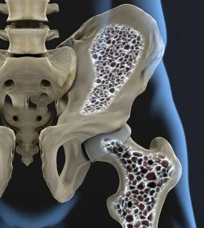 Ossos quebradissos: 4 passos para combater os primeiros sinais, segundo médico especialista do Osteoporosis Prevention and Treatment Center no Beth Israel Deaconess Medical Center