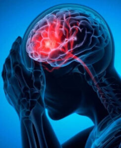 ATENÇÃO: 5 sintomas iniciais de AVC que exigem atenção imediata