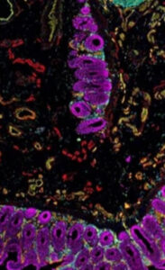 Câncer de intestino está aumentando em pessoas com menos de 50 anos; VEJA SINTOMAS