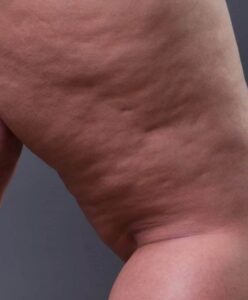 Por que o lipedema é mais comum em mulheres? Entenda sobre a doença de Yasmin Brunet