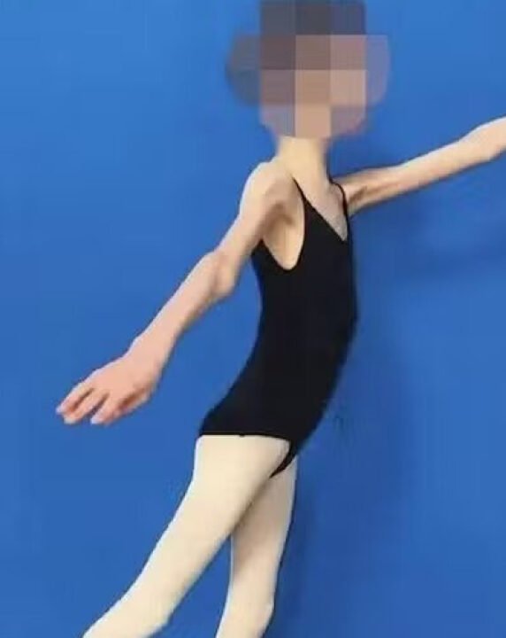 Pais são condenados por deixar filha bailarina de 20 anos chegar a pesar 27 quilos