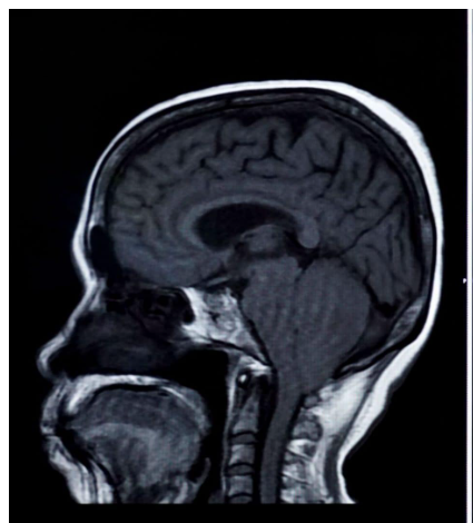 Você tem 3% de chance de ter um aneurisma cerebral sem saber