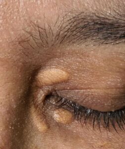 Xantoma: conheça a doença rara que pode atacar adeptos da dieta carnívora