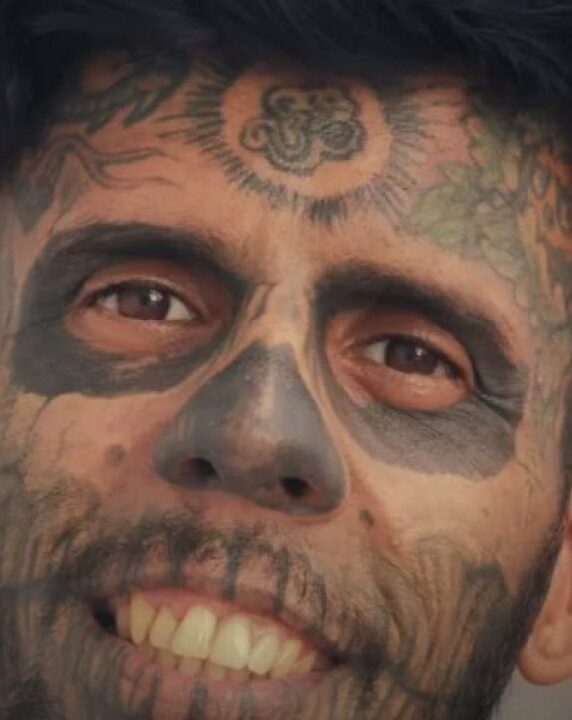 ‘Homem mais tatuado do Brasil’ exibe rosto após passar por sessão de remoção a laser