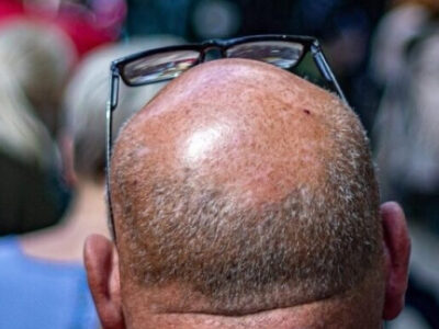 Fios de esperança: novo composto científico promete aposentadoria para a careca