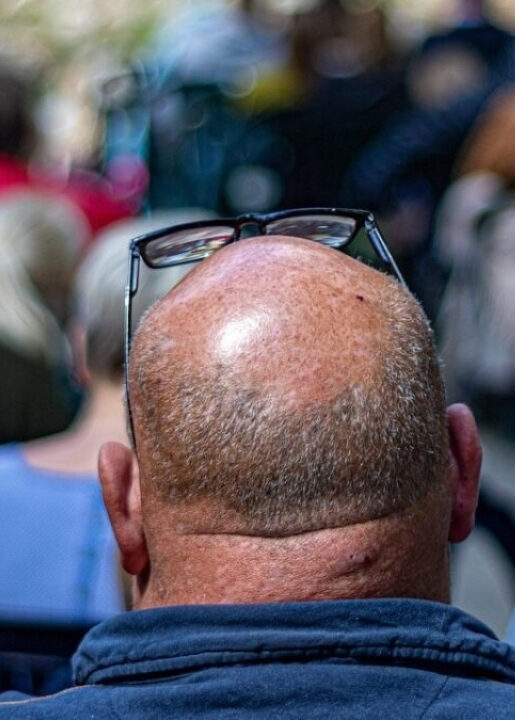 Fios de esperança: novo composto científico promete aposentadoria para a careca