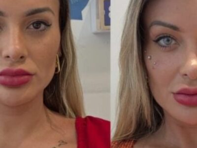 Queratopigmentação: Especialista alerta sobre os riscos da cirurgia que modifica a cor dos olhos, como algumas pessoas têm feito