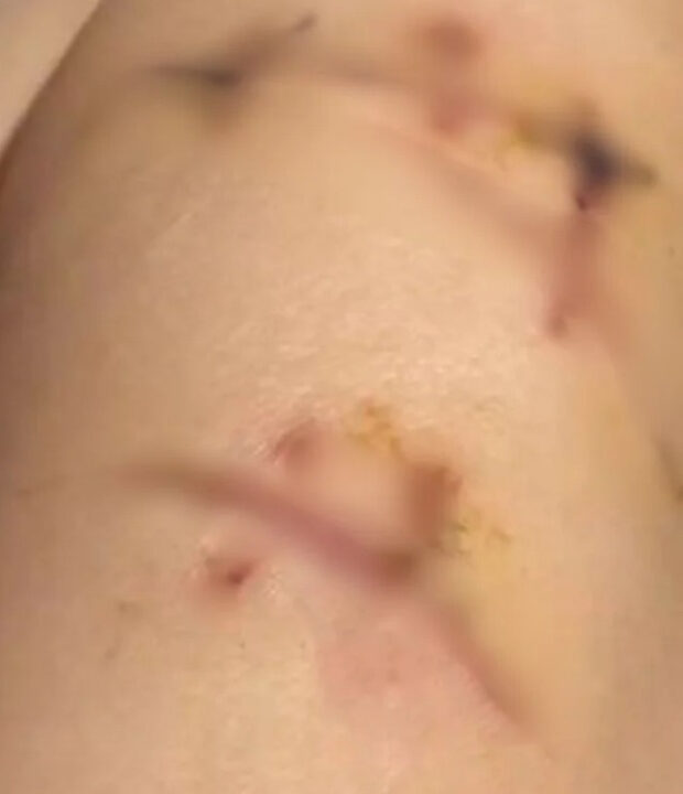Mulher sobrevive a 22 facadas no peito graças a implante de silicone