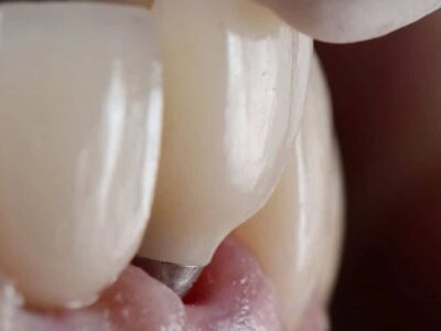 Implante dentário “inteligente” promete devolver sensibilidade ao sorriso