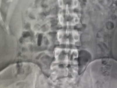 Barriga do crime: mecânico faz plano bizarro para traficar em prisão