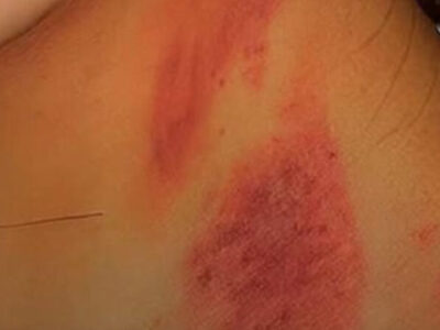 INUSITADO: Esposa aparece com marcas no pescoço e diz ter sido atacada por lobisomem