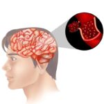 Ingestão adequada de zinco pode reduzir risco de AVC, aponta estudo. Conheça as principais fontes para não faltar no cardápio, segundo pesquisa no Scientific Reports e informações do Albert Einstein