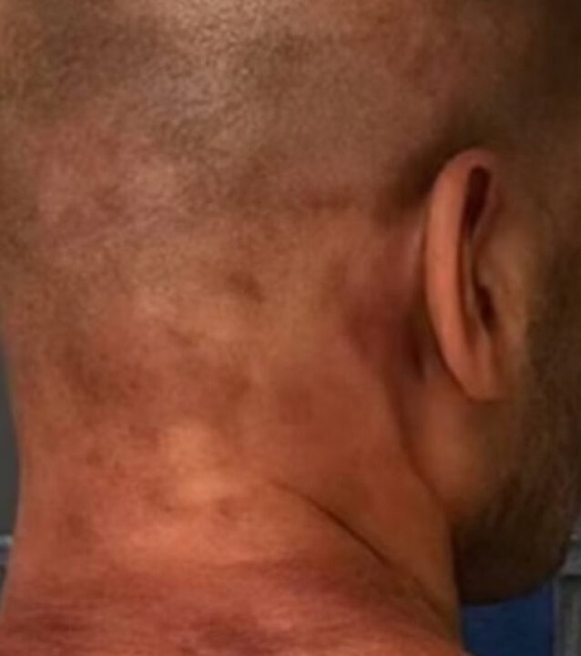 Veja foto de ex-jogador agredido na prisão após dar 61 socos em mulher