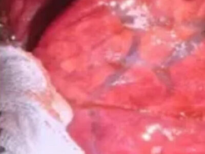 Pulmão de porco modificado é transplantado em homem pela 1ª vez