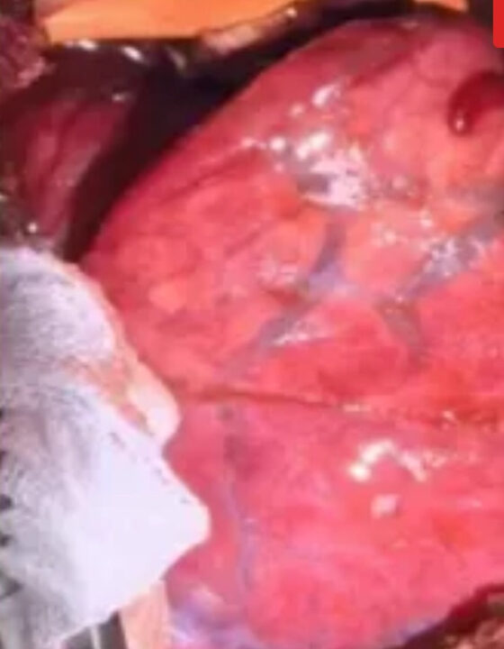 Pulmão de porco modificado é transplantado em homem pela 1ª vez