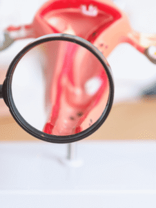 Exame de sangue pode detectar câncer de ovário em estágio inicial