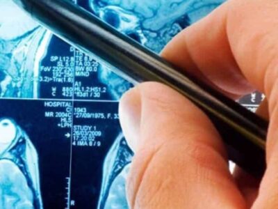 Novo método reverte sintomas de demência em testes