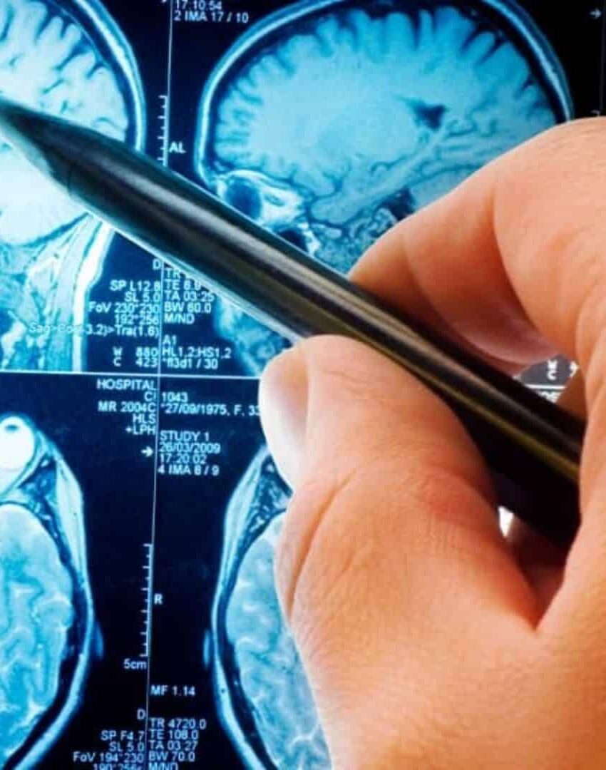 Novo método reverte sintomas de demência em testes