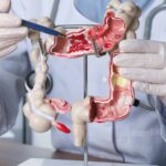Estes hábitos podem reduzir em até 30% o risco de câncer de intestino