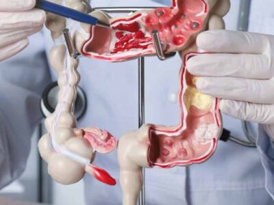 Estes hábitos podem reduzir em até 30% o risco de câncer de intestino