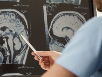 Câncer cerebral: entenda as promessas do medicamento recém-aprovado agora no Brasil. Ele ampliou em mais de 2 anos a sobrevida sem progressão da doença