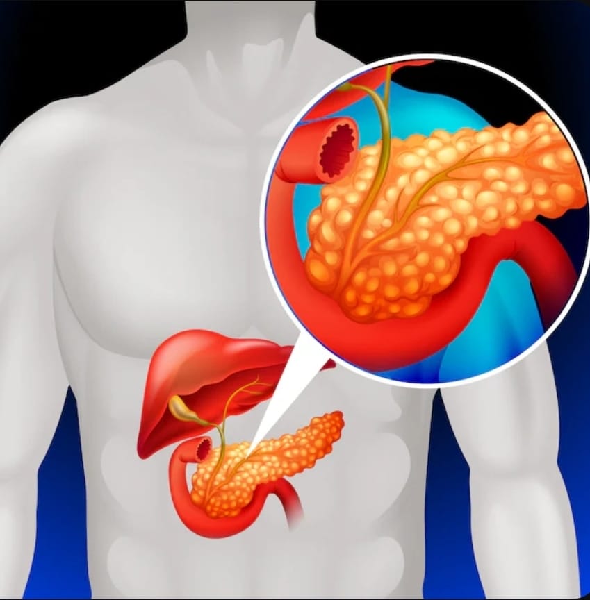 Fantástico: saiba como o transplante de ilhotas pode mudar o tratamento da diabetes tipo 1. Pesquisadores testam células editadas, dando inesperado passo em direção à cura