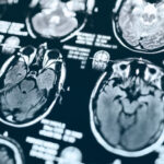 Novo tratamento para Alzheimer chega ao Brasil. Saiba como funciona