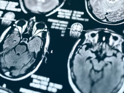 Novo tratamento para Alzheimer chega ao Brasil. Saiba como funciona