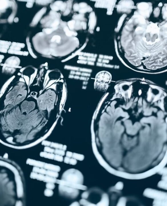 Novo tratamento para Alzheimer chega ao Brasil. Saiba como funciona