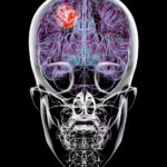 Dieta pode melhorar efeito de tratamento contra tumor cerebral grave