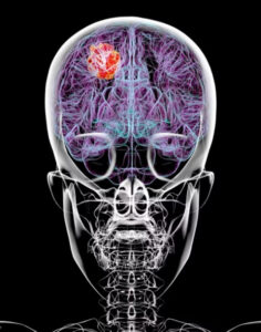 Dieta pode melhorar efeito de tratamento contra tumor cerebral grave