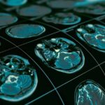 Autismo pode estar ligado à evolução rápida de neurônios, dizem cientistas