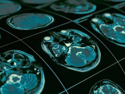 Autismo pode estar ligado à evolução rápida de neurônios, dizem cientistas