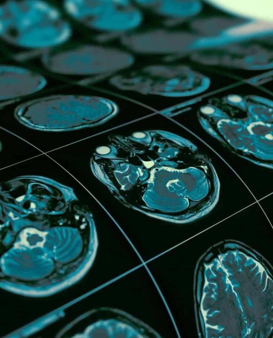 Autismo pode estar ligado à evolução rápida de neurônios, dizem cientistas