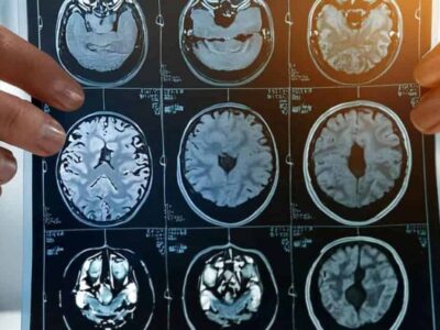 Estudo mostra que o autismo tem múltiplas origens — e isso muda como devemos entendê-lo