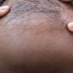 CARECA DOCE: composto de estévia faz crescer 67% mais cabelo em calvos