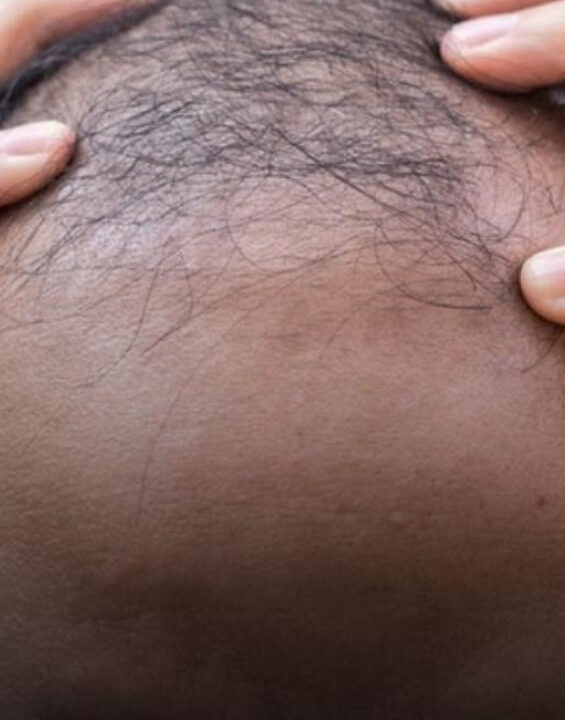 CARECA DOCE: composto de estévia faz crescer 67% mais cabelo em calvos