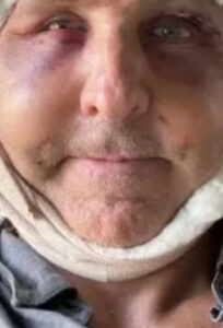 Homem que planeja viver até 180 anos implanta célula das nádegas no rosto