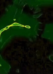 Casos de meningite aumentaram no país; saiba sintomas e como se prevenir; VÍDEO