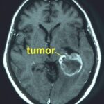 Nano-ivermectina intranasal reduz tumores cerebrais em 70% sem toxicidade. Confira estudo inovador de pesquisadores da Universidade Federal do Rio Grande do Sul, publicado na ACS Biomaterials Science & Engineering
