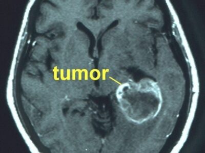 Nano-ivermectina intranasal reduz tumores cerebrais em 70% sem toxicidade. Confira estudo inovador de pesquisadores da Universidade Federal do Rio Grande do Sul, publicado na ACS Biomaterials Science & Engineering