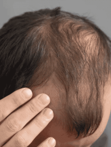 Fim da calvície? Nova pílula promete estimular crescimento capilar