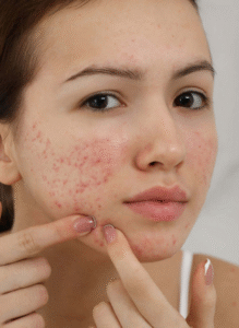 Fim da acne? Vacinas estão a caminho!