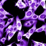 Induzir a morte celular no melanoma metastático pode abrir caminho para novos tratamentos contra o câncer. Estudo de Harvard relata que certos inibidores de proteínas podem ser tratamentos eficazes para a doença. Entenda