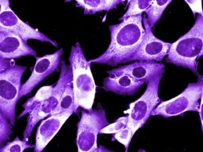 Induzir a morte celular no melanoma metastático pode abrir caminho para novos tratamentos contra o câncer. Estudo de Harvard relata que certos inibidores de proteínas podem ser tratamentos eficazes para a doença. Entenda