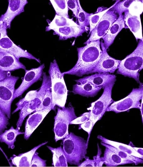 Induzir a morte celular no melanoma metastático pode abrir caminho para novos tratamentos contra o câncer. Estudo de Harvard relata que certos inibidores de proteínas podem ser tratamentos eficazes para a doença. Entenda