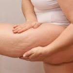 Você sabia que existe Celulite emocional? Sim, e pode ser causada por estresse contínuo. Especialista explica de forma simples as principais dúvidas das mulheres. Veja e entenda