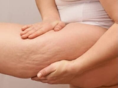 Você sabia que existe Celulite emocional? Sim, e pode ser causada por estresse contínuo. Especialista explica de forma simples as principais dúvidas das mulheres. Veja e entenda