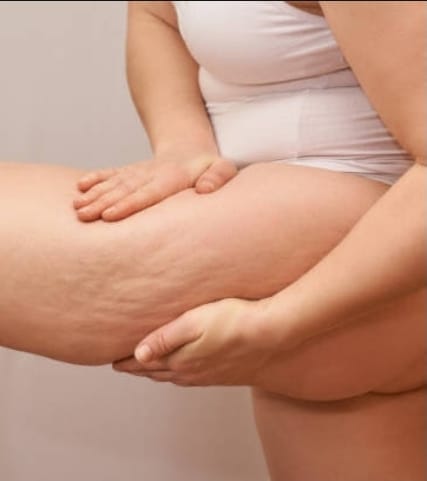 Você sabia que existe Celulite emocional? Sim, e pode ser causada por estresse contínuo. Especialista explica de forma simples as principais dúvidas das mulheres. Veja e entenda